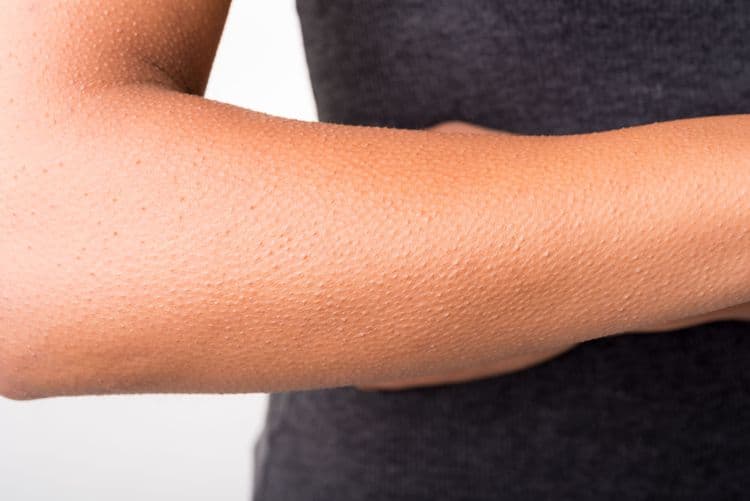The Science of Goosebumps—Why We Still Get Them